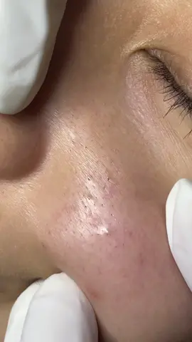 Mụn ẩn chân sâu trên nền da mỏng #goclamdep #hanaspaandclinic #hanatrimungovap #trimuntritham 