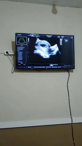 ini waktu detun usia 8 week, pertama kali denger USG dan Alhamdulillah udah ada djj nya 🥹🫀 sehat selalu ya nak sama ibu 🥰🫶 #bumil #pregnant #tm2 
