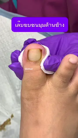 เล็บขบชนมุมด้านข้าง#ingrowntoenail #wefootตัดเล็บขบรักษาเล็บเชื้อรา #ตัดเล็บขบมียาชา #เล็บขบ #ตัดเล็บขบ #เล็บขบหนักมาก #เล็บขบหนักมาก #เล็บขบอักเสบ #wefootตัดเล็บขบสุดรากเล็บ 