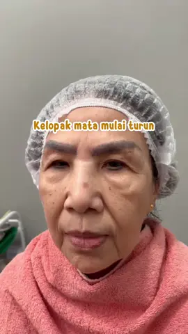 Ada yang punya keluhan kelopak mata turun ???  #klinikkecantikanjakarta #klinikkecantikan #skinbooster #browlifting #kelopakmataturun 