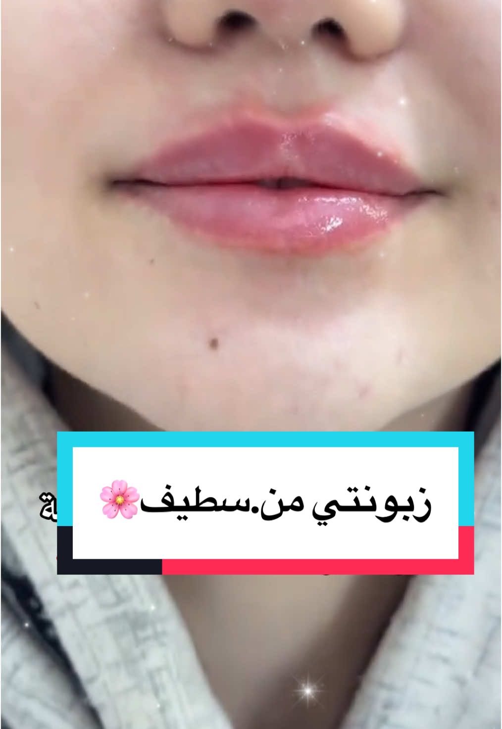 #fillerlèvres #botox #lèvrespulpeuses #esthétique #medecineesthetique #soinvisage #cliniqueesthetique #BeautyTok #GlowUp #faceaesthetics #lipfiller #botoxinjections #aestheticclinic #beforeandafter #naturalresults #BeautyTok #GlowUp #faceaesthetics #dermalfillers #antiaging.  #تجميل #بوتوكس #فيلر #شفايف #شفايف_طبيعية #طب_تجميلي #جمال_الجزائر #تجميل_الجزائر #جمالك_يهمنا #بشرة_صافية #شفايف_فيلر #esthétique #botox #fillerlèvres #lèvrespulpeuses #medecineesthetique #beautealgerie #algerie #sétif #blida #lipfiller #soinvisage #antiage #cliniqueesthetique #esthetiquealgerie #TikTokBeauty 
