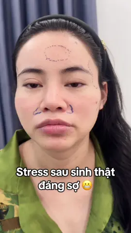 Xinh sxac lun ạ 🥰 combo mà chỉ hết có 4cc quá rẻ 999k/1cc lấy lại thanh xuân. #taitailoc #mábaby #trandep  #rãnhcuoi #tháiduong #filler #fillerbottoxchuanykhoa #môicherry #xuhuongtiktok 