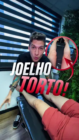 🦵 Joelho valgo ou joelho varo: você sabe qual é o seu? A Queka tem joelho valgo, que faz ela pisar mais na parte interna do pé 👣. Isso pode causar dores e mudar seu jeito de caminhar. Ela fez tração e tratamento pra melhorar o alinhamento e a pisada! 💪 Se identifica com isso? Então não deixe de cuidar do seu joelho! Agende sua avaliação e venha entender o que seu corpo precisa! 🙌 #JoelhoValgo #JoelhoVaro #QueroQuiro #PisadaSaudável #CuideDoSeuCorpo #Quiropraxia