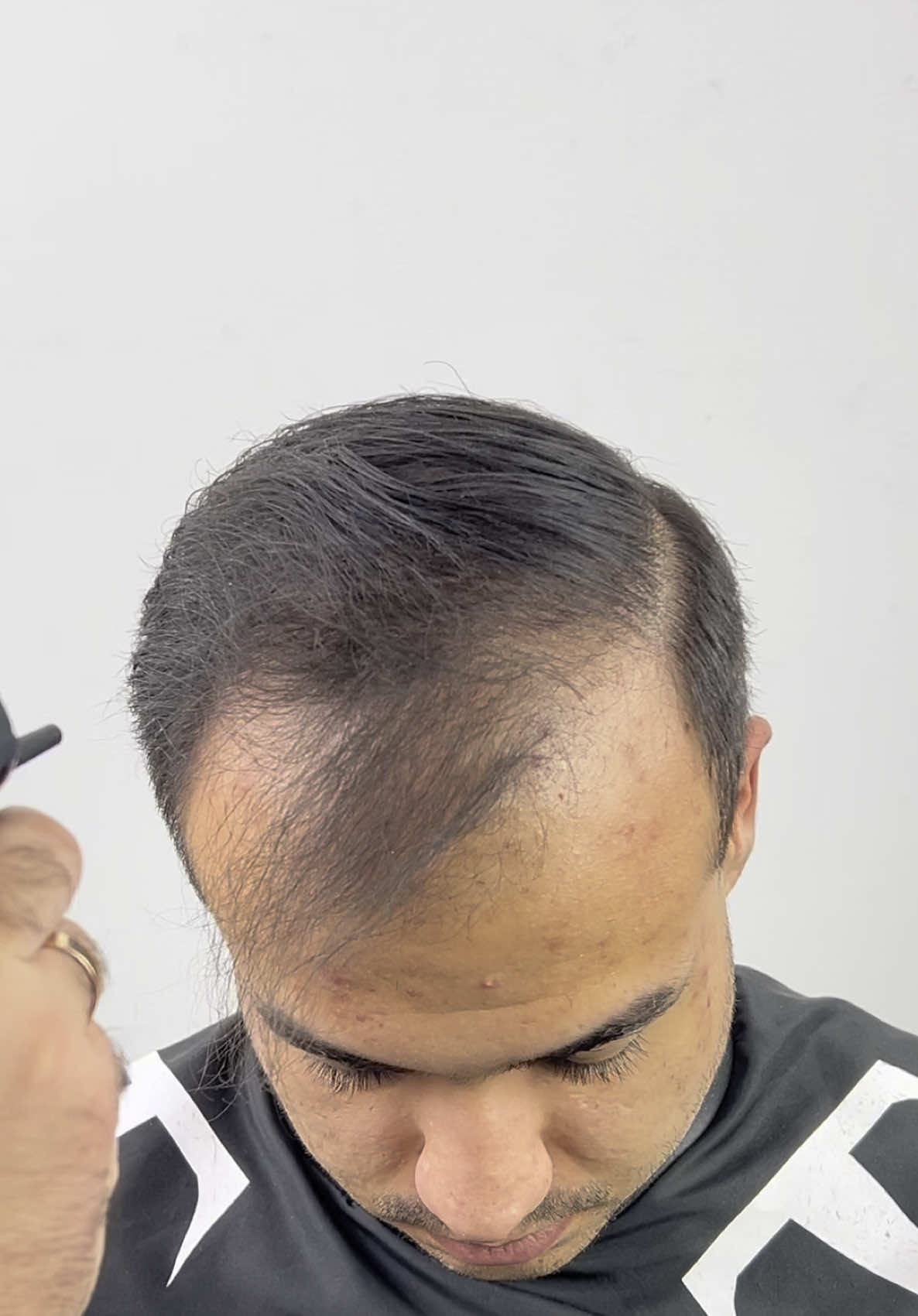 Using hair fibers can cover thinning hair effectively. Gently tap the fibers into the hair for natural-looking results. Our hair spray can then be used to hold the fibers in place for 24 hours or longer. The brand we are using is THICK FIBER. Amazing transformation comment below and let us know what you think of this transformation  #thickfiber #hairfiber #hairenhancement #thinninghair #baldspots #crownhairstyle hairfibres #hairbuildingfibers #hairthickness 