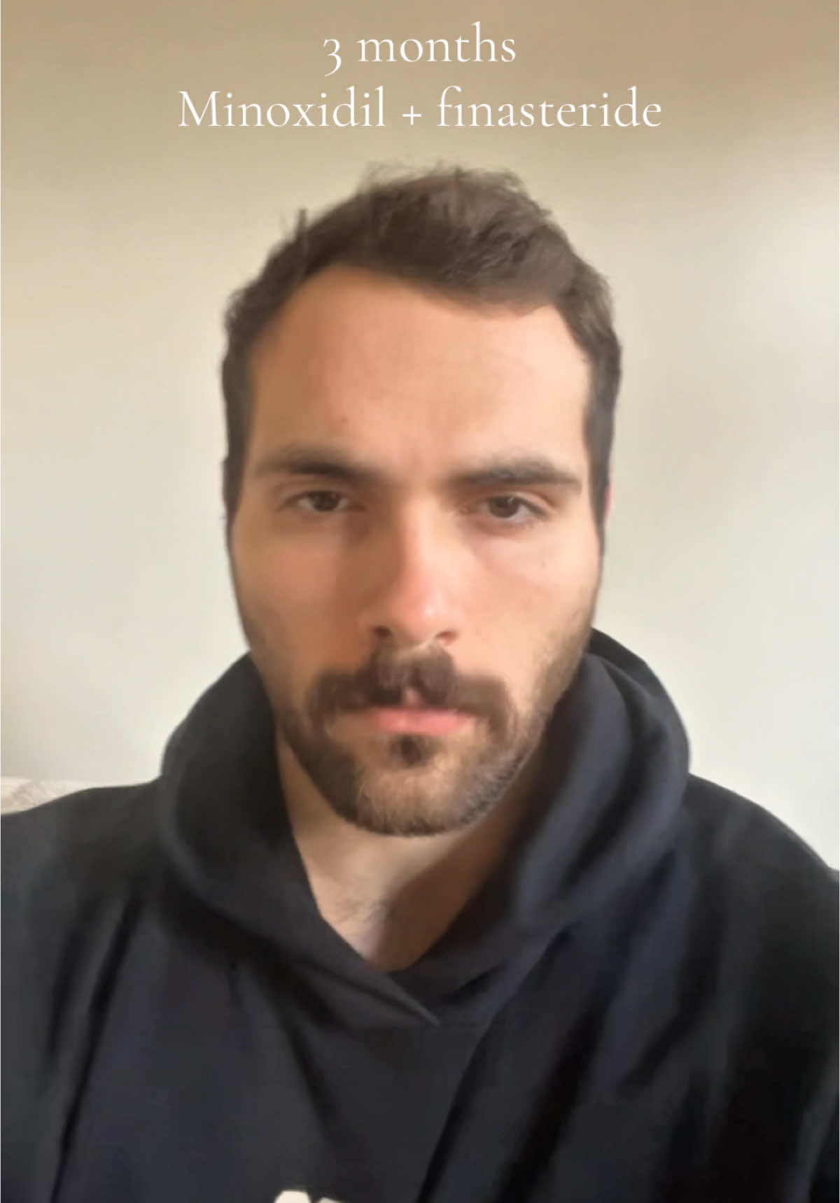 I locked in. Feel free to ask me any questions in the comments!#fyppppppppppppppppppppppp #minoxidil #finasteride #hairtransformation #transformation 