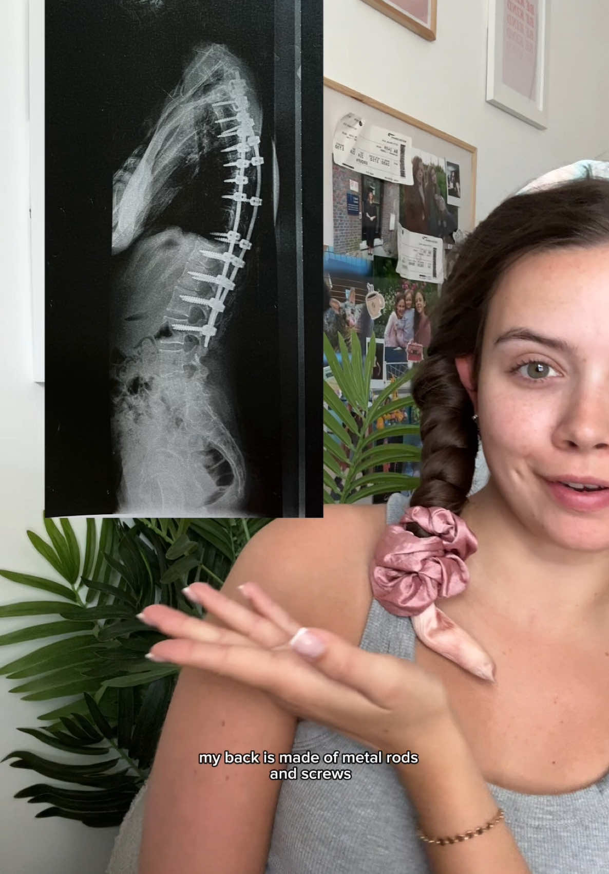 it’s scoliosis awareness month so let’s talk about it…  When I was diagnosed with scoliosis at 11 my world crumbled and I thought there was no point living with scoliosis, and I wish I could go back and tell that girl that life is worth living with scoliosis and after a few very hard years she would get to live a relatively normal life 💗  SSR helpline: 02089641166  https://ssr.org.uk/contact-us #scoliosis #scoliosisawareness #scoliosisawarenessmonth #spinalfusion @Garnier @L'Oréal Paris UK @ETERNAL MUSE 