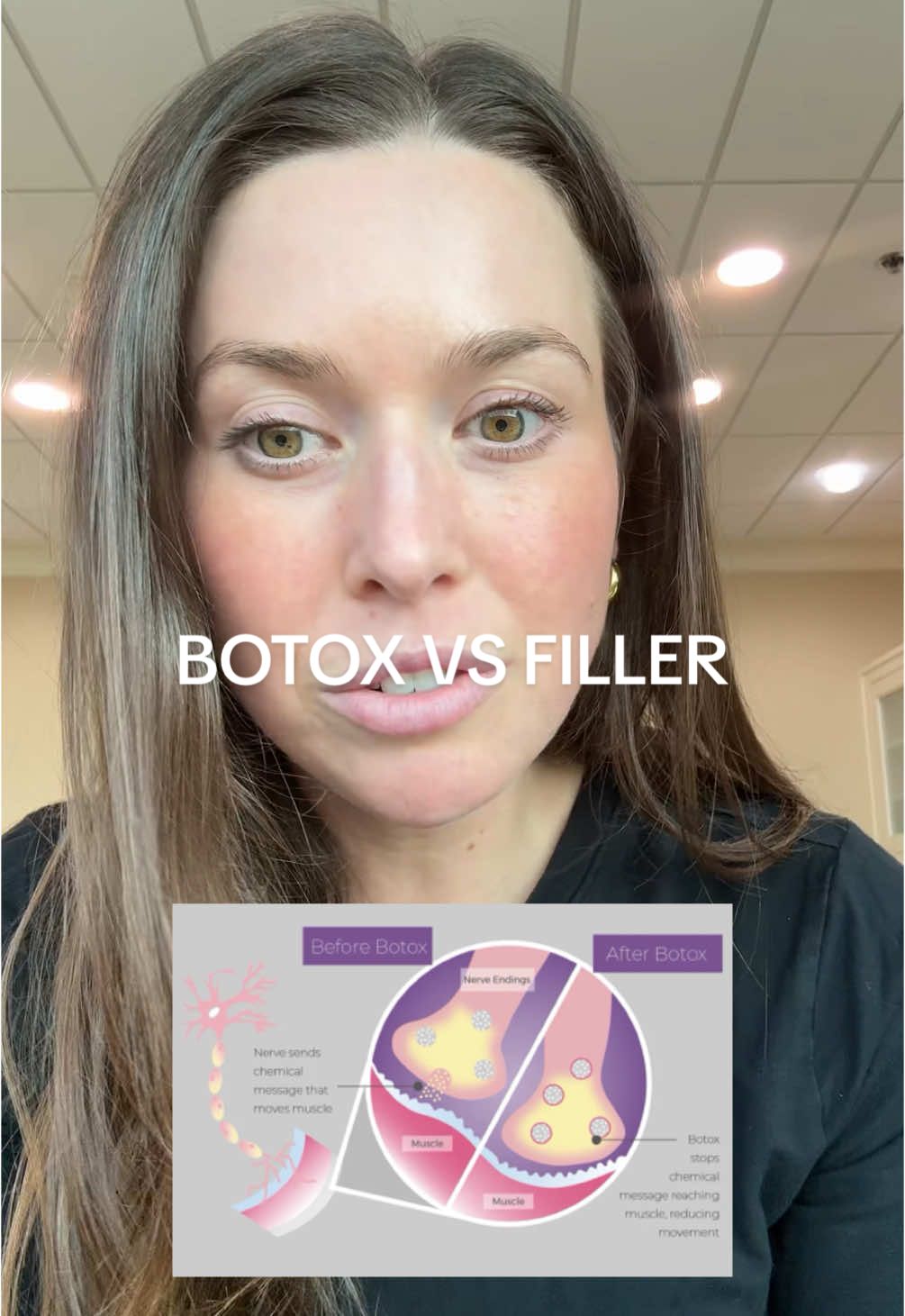 Botox vs filler #atlantainjector #botox #filler 