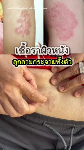 เชื้อราผิวหนัง ใครเป็นอยู่อย่ารอช้า 👉🏻 #ครีมสมุนไพรพญายอพลูคาว #ครีมทาผื่น #ครีมพญายอพลูคาว #เชื้อราผิวหนัง #คัน #ผื่นคัน #ผื่นแพ้ #สะเก็ดเงิน #กลากเกลื้อน #ลมพิษ 