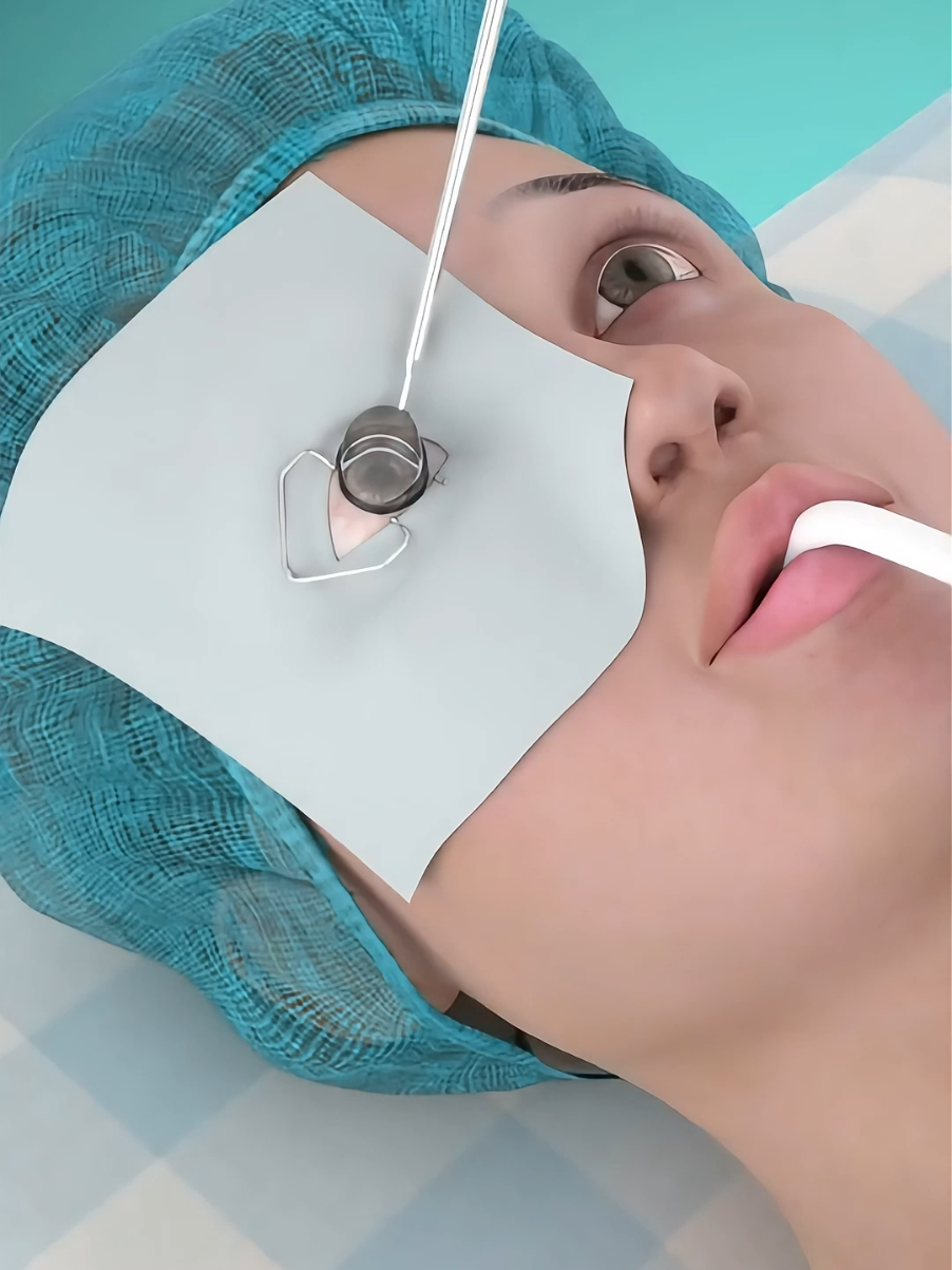 Micro-incision Phacoemulsification Cataract Surgery (MICS) 3D Animation  #cataractsurgery #cataract #cataracts #microincisionphacoemulsification #3dmedicalanimation #medical3danimation 