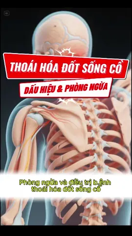 Giới thiệu về B.ệnh Thoái Hoá Đốt Sống Cổ #thoaihoadotsongco #tuephucan #dauhieu