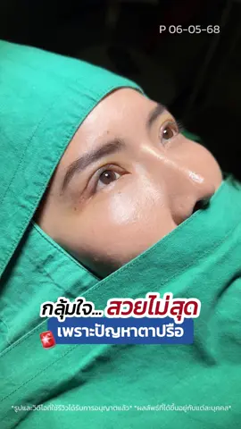 กลุ้มใจ สวยไม่สุด‼️ เพราะปัญหาตาปรือ #รีวิวตาสองชั้น #หมอสกาย #skyclinic #ศัลยกรรมตา #สกายคลินิก #ทำตาที่ไหนดี #จักษุแพทย์ 