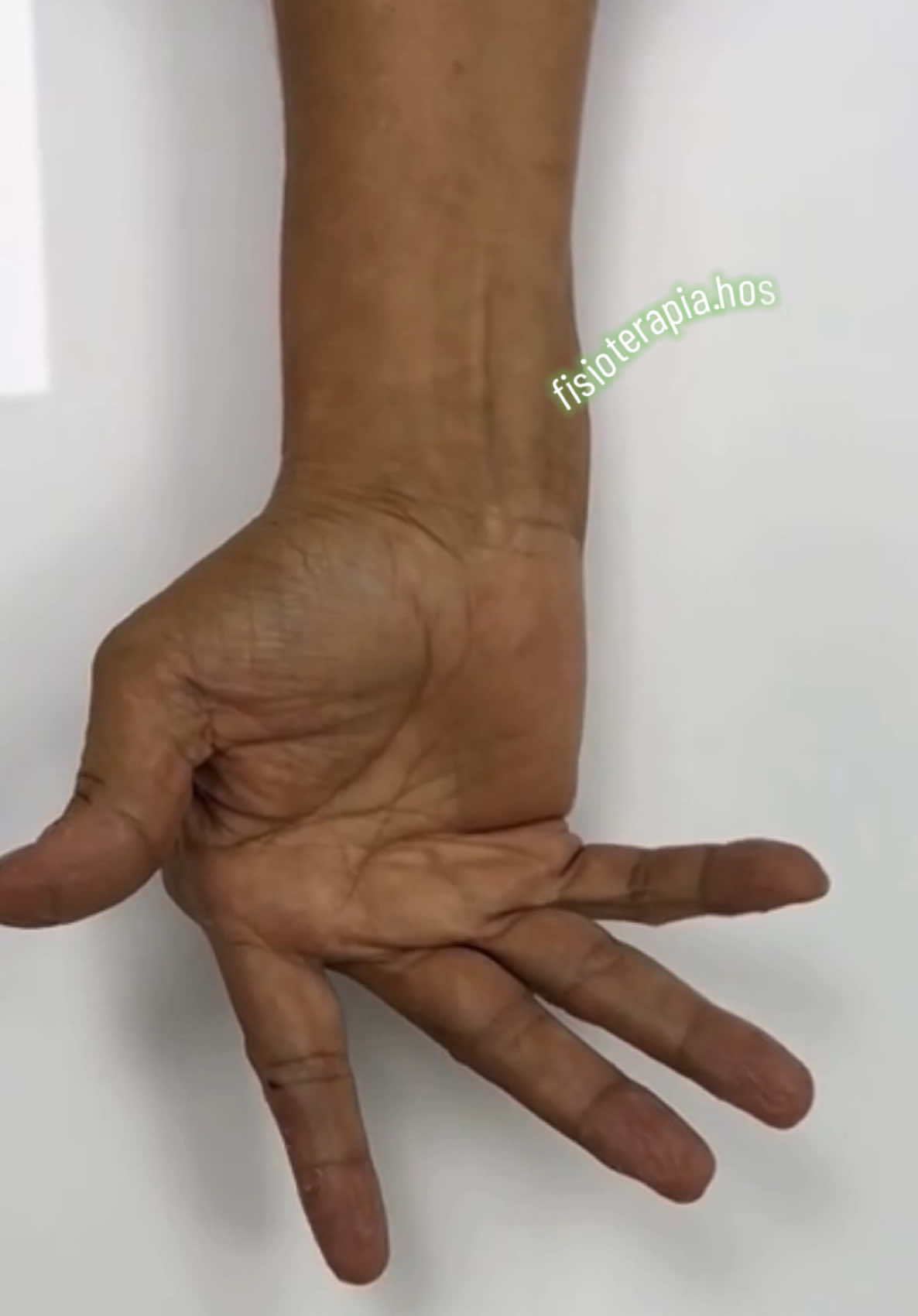 A artrite reumatoide é uma doença autoimune crônica e inflamatória que afeta principalmente as articulações, causando dor, inchaço, rigidez e perda de função. Ela é simétrica (atinge os dois lados do corpo) e pode levar à destruição articular e deformidades, especialmente nas mãos. 🔹 Características principais: 	•	Inflamação persistente das articulações 	•	Rigidez matinal prolongada (>30 minutos) 	•	Fadiga e mal-estar geral 	•	Evolução progressiva, com possível destruição das articulações 	•	Afeta mais mulheres entre 30 e 60 anos 💊 Tratamento O objetivo é controlar a inflamação, aliviar os sintomas e prevenir deformidades. Pode incluir: 	•	Medicamentos modificadores da doença (DMARDs): metotrexato, leflunomida, sulfassalazina 	•	Biológicos: adalimumabe, etanercepte, tocilizumabe, entre outros 	•	Anti-inflamatórios e corticoides (uso controlado) 	•	Fisioterapia e exercícios regulares 	•	Em alguns casos, cirurgia ✋ Principais Deformidades das Mãos na AR A progressão da doença pode causar alterações anatômicas visíveis e funcionais nas mãos. As mais comuns são: ⸻ 1. Dedo em Pescoço de Cisne 	•	Hiperextensão da articulação do meio do dedo (interfalângica proximal) 	•	Flexão da articulação da ponta (interfalângica distal) 	•	Dedo adquire a forma de um pescoço de cisne. ⸻ 2. Dedo em Botão de Casaca 	•	Flexão da articulação do meio do dedo 	•	Hiperextensão da articulação da ponta 	•	Parece que o dedo está “dobrado para dentro” no meio. ⸻ 3. Desvio Ulnar dos Dedos 	•	Os dedos são desviados em direção ao lado do dedo mínimo (lado ulnar da mão). 	•	É causado pela destruição da articulação metacarpofalângica (base dos dedos). ⸻ 4. Subluxação e Instabilidade Articular 	•	As articulações perdem o alinhamento normal. 	•	Pode haver “deslocamentos parciais” frequentes, causando dor e perda de função. ⸻ 5. Atrofia Muscular e Rigidez 	•	Os músculos ao redor da mão podem enfraquecer. 	•	A rigidez articular pode limitar movimentos finos (como escrever, abotoar roupas). ⸻ A artrite reumatoide (AR) pode e costuma atingir várias articulações do corpo, não apenas as das mãos. Ela é uma doença sistêmica e simétrica, o que significa que pode afetar múltiplas articulações em ambos os lados do corpo ao mesmo tempo. #artritereumatoide #fisioterapia #artritereumatóide #fisioterapeuta 