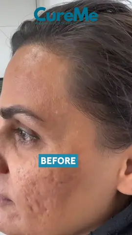Say goodbye to acne scars! 💫 Our advanced treatments: ✨ Reduce appearance of scars ✨ Improve skin texture and tone ✨ Boost collagen production Book now and reveal smoother, clearer skin! 🌸 #AcneScarTreatment #SkinRejuvenation #ScarRemoval #GlowingSkin #SkinCareSolutions #BeautyTreatments #curememedicalcomplex #cmc #cureme #curememedical 