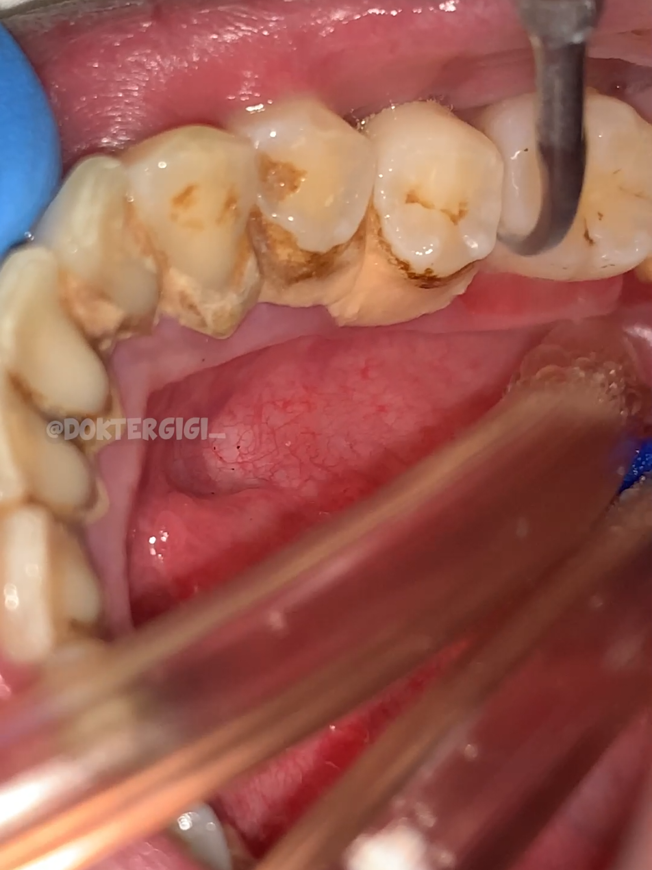 #doktergigitriputra #doktergigi #SatisfyingVideo 