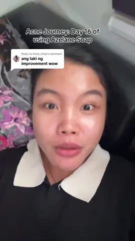 Replying to @Anne_shop Documenting my Acne Journey using the Azelane soap #acneproneskin #acneskin #acnejourney 