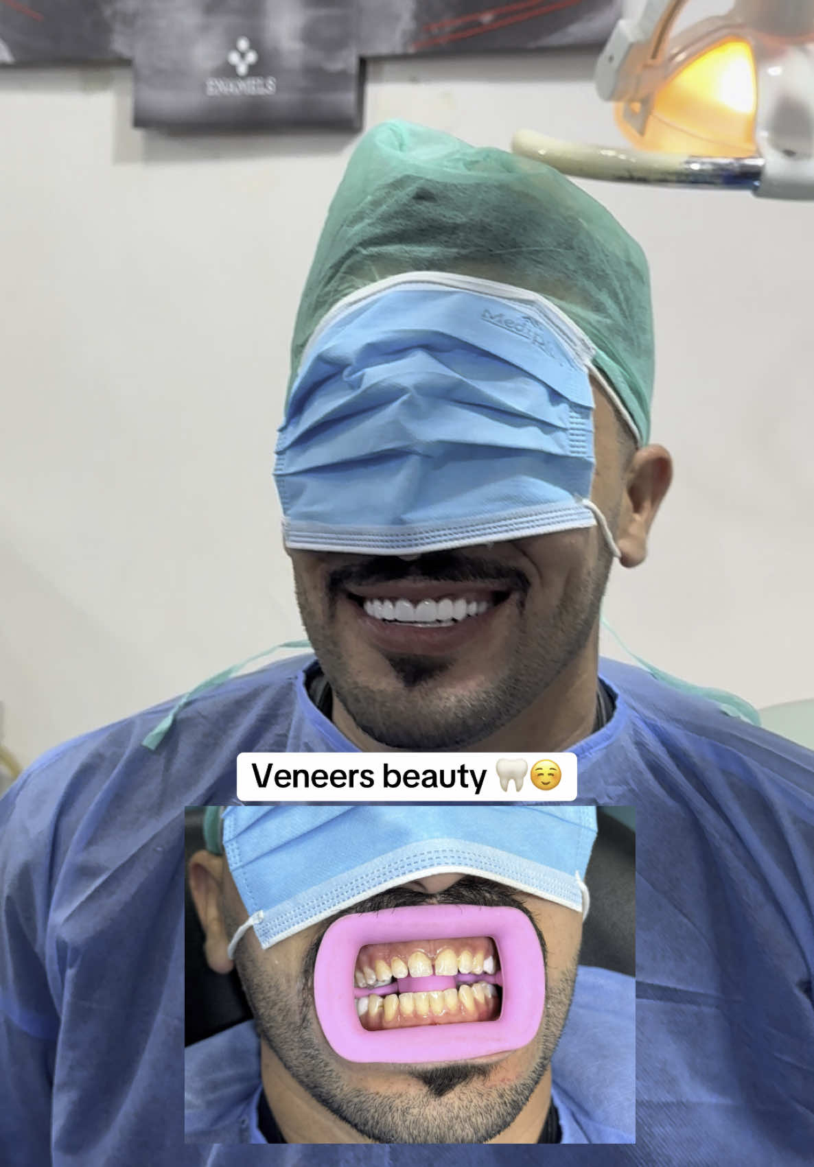 Veneers beauty 🦷#fypage #fypage #fypage #fyp #fyp #fypage #fypage #fypage #fypage #fypage #unfrezzmyaccount #off #implantedental #viralvideo #foryoupage #doctorbilalofficail 