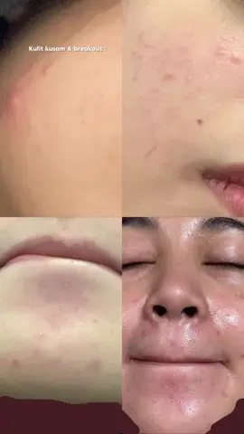No more kulit kusam ! Jangan lupa grab sekarang @Skintific.my  #skintific #skintificmy #377moisturizer #darkspotmoist #skintificmoisturizer #darkspots #acnescars 