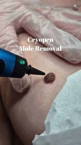 Remove moles quickly and easily right here at Beauty Secrets!⁠ ⁠ With Cryopen, we are able to effectively remove benign moles and skin lesions through cryotherapy ✅⁠ ⁠ It's never been more important to protect your skin with SPF! 🔆 We love the products from Heliocare, why not stock up next time you're in salon? ⁠ ⁠ #beauty #moleremoval #skintagremoval⁠