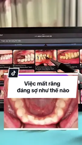 Việc mất răng đáng sợ như thế nào? #bsvovanthien #fyp #chamsocrangmieng #matrang #shorts 