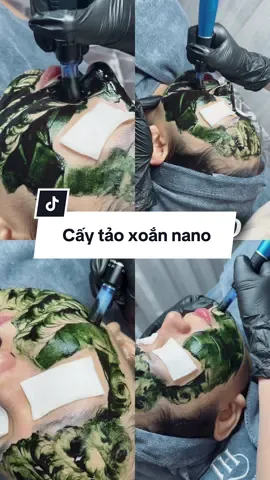 Cấy 1 lần là mê luôn 😍 #viral #xuhuong #spa #spahanoi #spahadong #caytao #caytaoxoan 