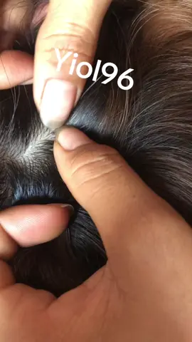 Remove Lice#omg🙀🙀😱😱❤️ #lice #liceremoval 