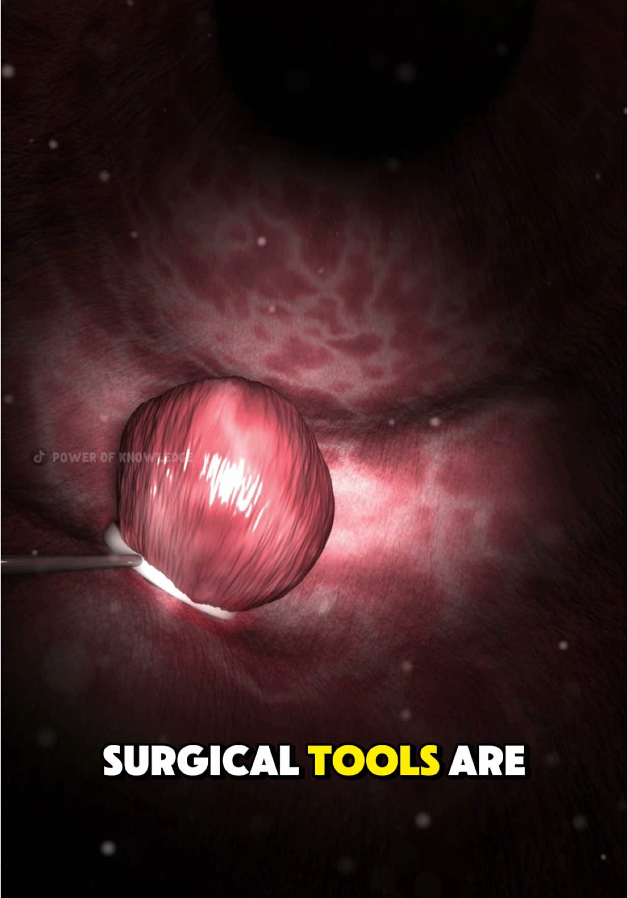 How Uterine Polyps Are Removed? (3D Animation) #uterinepolyps #uterinepolyp #uterinepolypsawreness #uterusproblems #polypectomy #uterinepolypectomy #medical3danimation #3dmedicalanimation 