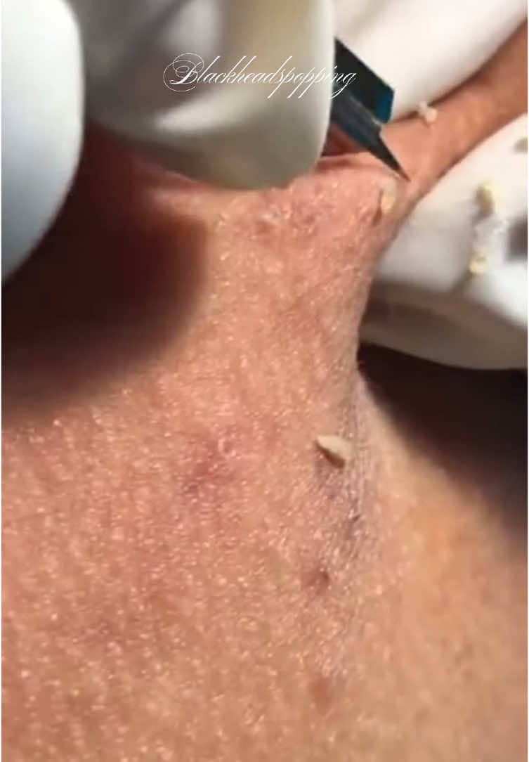 Blackheads 🥰#blackhead#tiktoklongs#relaxing#extration#😍😍😍#skincare#fouryou#explore#pimples 
