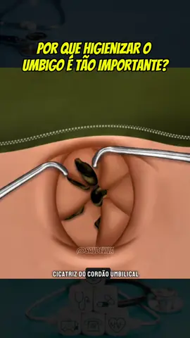 Umbigo limpo evita infecções, odores e bactérias. Um cuidado simples que protege sua pele diariamente.#saude #anatomia #corpo #saudeemfoco #bemestar 