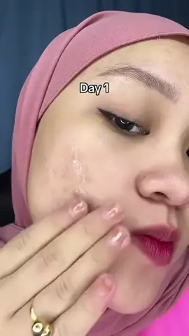 Mengubah kulit anda serta-merta! Gunakan LandiHome Turmeric Cream setiap hari: Formula Korea terbukti 10 kali ganda lebih berkesan daripada krim biasa!#Kunyit #Jerawat #KrimMuka #Melasma #foryou #KrimKunyit