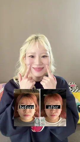 笑った時のむっちり頬は脂肪ではない場合がほとんどです！痩せて顔変わりましたか？変わらなかった人は脂肪ではなく筋肉の凝りです！！！！#小顔矯正 #小顔マッサージ #頬肉 #顔痩せ 