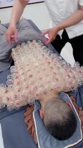 [ASMR] 拔罐- Cupping Therapy with 105 mini cups #cuppingtherapy #asmr #trilieuhaiphong #Giachoi #massage 