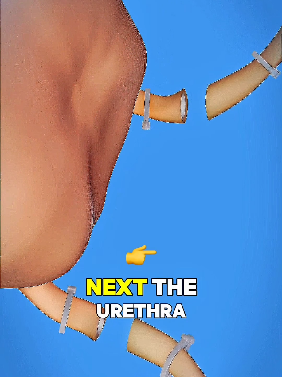 Life-Saving Surgery: How Doctors Remove Bladder Cancer Step-by-Step 🏥💪 #BladderCancer #CancerSurgery #LifeSavingTreatment #HealthAwareness #MedicalExplained #TikTokHealth #OncologyCare #SurgicalJourney #FightCancer #UrinaryHealth