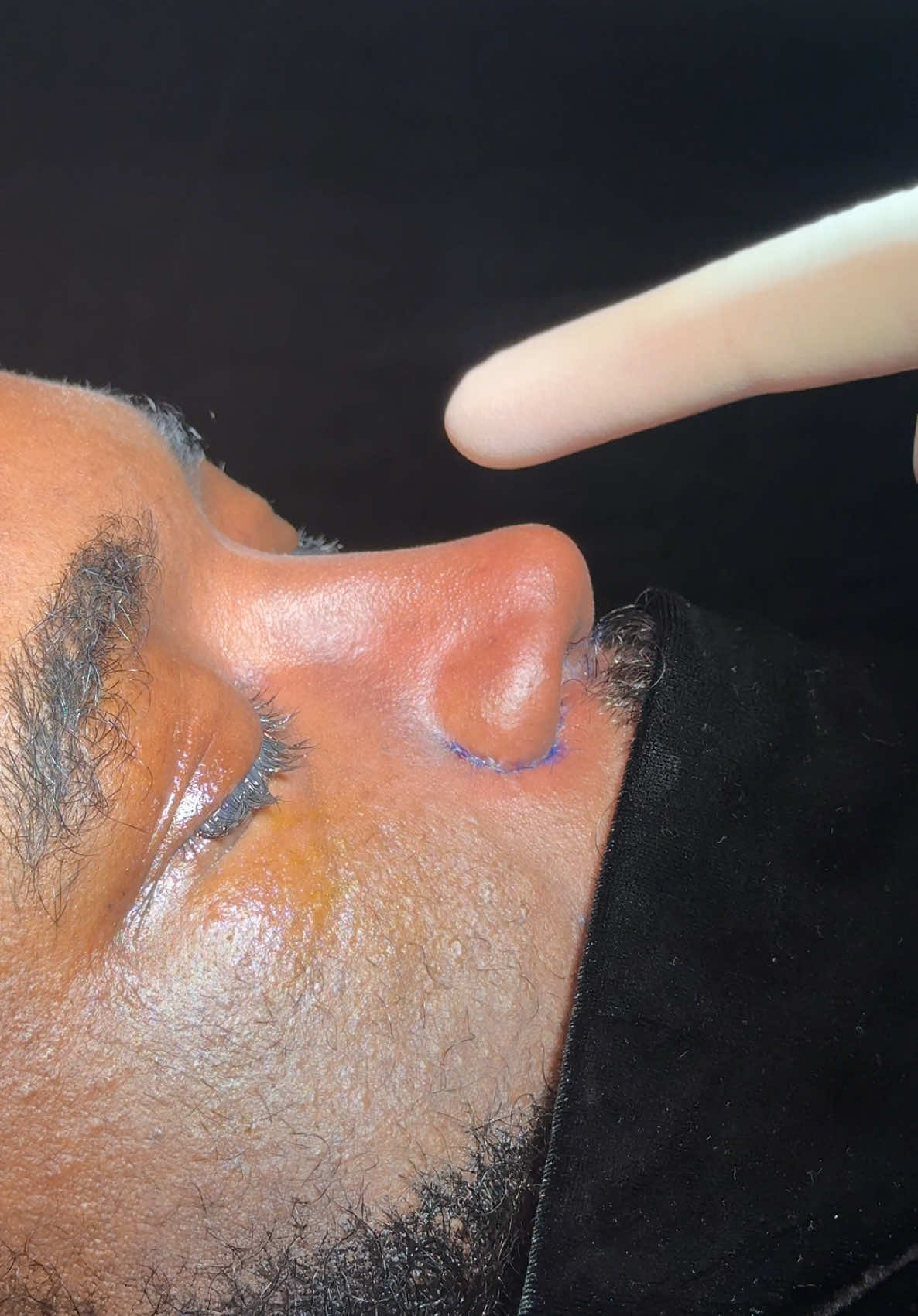 This  gentleman underwent a rhinoplasty where definition was enhanced without compromising his ethnic identity. Preserving natural harmony and cultural features is not only possible—it’s essential. 👃🏽 Ethnic rhinoplasty is not about changing who you are. It’s about revealing the most refined version of you. 🎯 Performed by Dr. Harun Acipayam #EthnicRhinoplasty #BlackExcellence #NoseDefinition #RhinoplastyTransformation #FacialHarmony #DrHarunAcipayam #NaturalResults #EthnicBeauty #RhinoplastieEthnique #BeautéNaturelle #HarmonieFaciale #ChirurgieEsthétique #NezDéfini #DrHarunAcipayam #RésultatsNaturels #fiertéethnique 