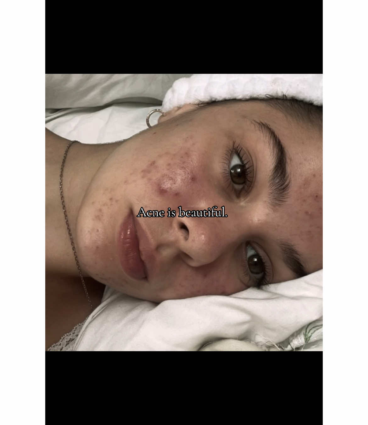 #acne #beauty #acnepositivity #ennuit #fy 