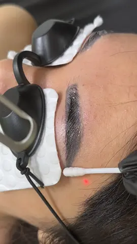 Tạm biệt lông mày đậm #xoalaser #laserhairremoval #lasertattooremoval #lasermarking #xoá_xăm #xoá_sửa_chân_mày #trend #beauty 