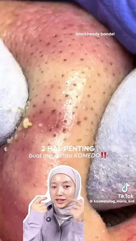 Double cleansing pake cleansing oil + eksfoliasi pake peeling serum BHA = bye komedo 🤌🏻✨ Disclaimer : hasil bisa berbeda tergantung kondisi kulit masing-masing, lama waktu pemakaian, dll. yaa Sc video di awal : kosmetologmaria_maria_krd #widymeisya #rekomenwidsky #racunwidmey #skincarewidy #elformulawidy #peelingserum #peelingserumelformula #elformula #elformulapeelingserum #sebaceousfilament #tipskomedo #blackheads 