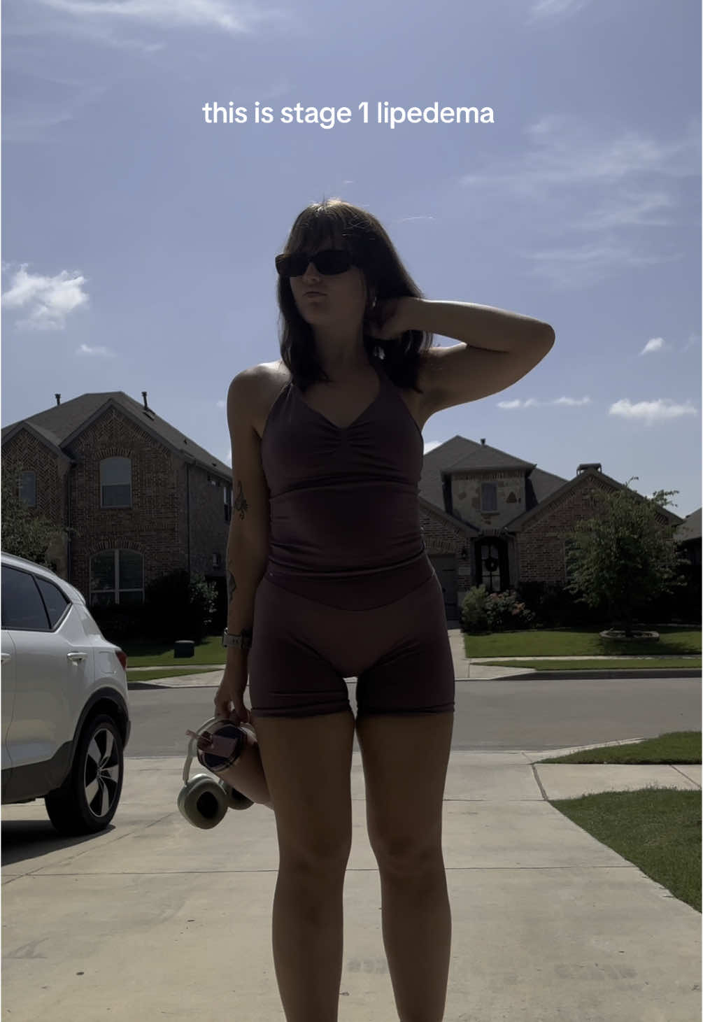 I’ve always known my legs were different. Since puberty, they’ve been heavy, painful, and shaped unlike the rest of my body. I’ve been told my whole life that I’m just overweight. But now I finally have a name for it—lipedema. It’s a chronic fat disorder that mostly affects women. It causes painful fat buildup in the legs, swelling, easy bruising, and it doesn’t respond to diet or exercise. My legs hurt daily. They’re always covered in bruises. People constantly ask me about them. It’s exhausting. Right now I’m managing it with compression, lymphatic drainage, and an anti-inflammatory diet. I’m also exploring surgery in the coming months to get some relief. I’m sharing this because so many women live with this and are misdiagnosed or ignored 💔 #lipedema 