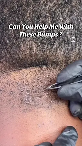 Struggling with painful razor bumps or severe irritation on the back of your head or neck? You’re not alone — and you’re not without options. I specialize in treating AKN (Acne Keloidalis Nuchae), helping men regain their confidence and comfort through proven, professional treatments. ✅ Accepting NEW clients now ✅ Safe, private, and judgment-free care ✅ Results-driven treatment plans tailored to your case If you’re tired of hiding your skin or dealing with constant irritation, I’m here to help you heal. 👉 Comment “HELP” below and I’ll personally reach out