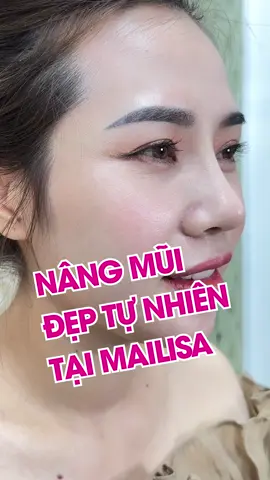 Review nâng mũi tại Mailisa. Mailisa nâng mũi sụn Softxil bọc Megaderm giá 15 triệu có đẹp tự nhiên không? Theo dõi ngay video sau để chiêm ngưỡng chiếc mũi đẹp chị khách hàng sau khi nâng mũi tại Mailisa nhé! #Mailisa #mailisagroup #lamdepmailisa #GocLamDep #trending #xuhuong #nangmui #nangmuidep #nangmuiuytin #pttm #phauthuatthammy #mailisa #lamdep #tmvmailisa #nangmui #phauthuat #phauthuatthammy