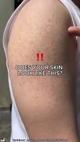 PHIlang tao kaya ang hindi naglalabas ng kanilang braso o nag-suot ng sleeveless dahil sa pimples/tigyawat?😨 👇Sana hindi lang ako ang ganito!#ance #fyp #bobywash #acne #bodywash #skin #fypシ #quarxery #hairremoval #mite #foryou #bacne #foryoupage #clean #mites #body #Moisturizing #bodycare #Keratosispilaris