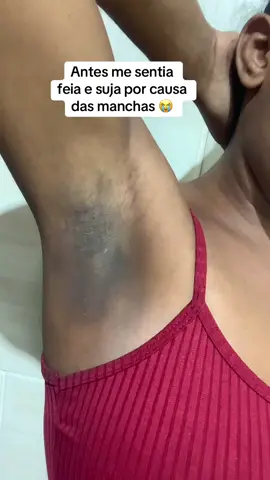 Uma nova Mulher🥺🤌🏻 #axilas #manchas #clareadordemanchas 