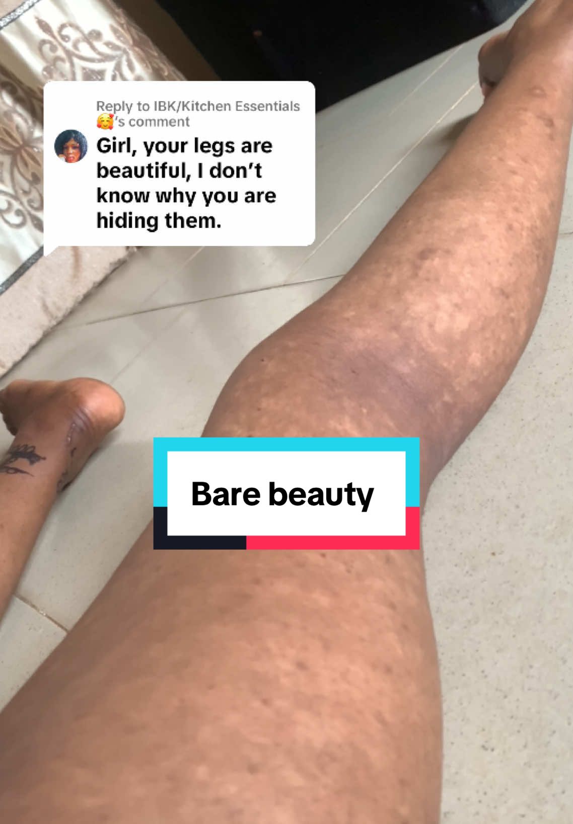 Replying to @IBK/Kitchen Essentials 🥰  “But your legs look fine…” Zoom in. This is post-inflammatory hypopigmentation. This is what pityriasis rosea left behind. This is what healing skin can look like — even if you don’t see it at first glance. I’m not hiding anything. I just no longer need to prove my scars to be valid. Some skin conditions aren’t always loud — but they’re real. And yes, I am on journey to self love which includes wearing  whatever I like. B#Because can. Because I deserve to.  #T#ThisIsMySkinS#SkinConditionAwarenessP#PityriasisRoseaP#PostInflammatoryHypopigmentationR#RealSkinUnfilteredS#SkinWithAStoryB#BoldSkinMovementC#ConfidentInMySkinM#MelaninHealingS#SkinIsSkinB#BeautyBeyondFiltersNoMoreHiding #plcawareness 