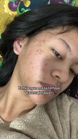 Jujur sedih banget karna Jerawat aku jadi kehilangan diri sendiri #acne #acnefighter #acnetreatment #jerawat #insecure 