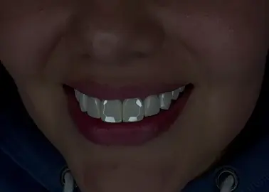 💎✨ Another stunning transformation at NovaStudio From natural to next-level brilliance — our patient now shines with diamond-cut veneers. Every facet was designed to reflect light like a fine gem. The result? A smile that turns heads and tells a story of elegance. Because this isn’t just cosmetic dentistry — it’s smile artistry. 💬 What do you think of this glow-up? Drop a ✨ in the comments! — #DiamondVeneers #SmileTransformation #LuxurySmile #CrystalSmile #FacetedVeneers #ZirconiaVeneers #HollywoodSmile #DesignerVeneers #ShineYourSmile #ToothArt #NextGenSmile #SmileGoals #viral #fyp #reels #explore #trending #luxury #art #style #beauty #aesthetic #beforeandafter #GlowUp #worldwide