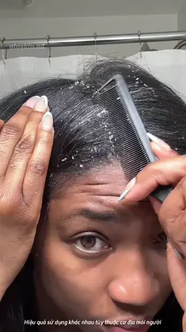 Gàu mảng - nấm da đầu thì tham khảo ngay sản phẩm này nha#gàu #nấmdađầu