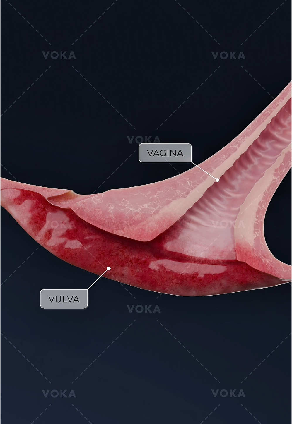 What is vulvitis and how is it treated?   Vulvitis is an inflammation of the external female genitalia, including the labia majora, labia minora, clitoris, and vaginal vestibule. This condition can cause a variety of symptoms such as itching, burning, redness, swelling, and pain.   The treatment approach for vulvitis varies depending on the underlying cause of the inflammation. Whether due to infections, allergies, or other irritants, a proper diagnosis is essential for effective treatment.   📌 Learn more about vulvitis and its treatment with our application - VOKA 3D Anatomy & Pathology!   #vulvitis #femalegenitalhealth #gynecology #womenshealth #anatomy #pathology #3danatomy #medstudents #medicalstudents #medicaltsudent #digitallearning #humanbody 