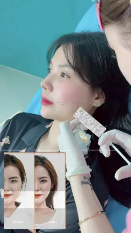 Botox បង្រួមសាច់ដុំថ្គាម ធានាស្រកតាំងពីចាក់លើកដំបូង , ចំពោះការចាក់លើកទីពីរ ពួកយើងមាន free ជូនម្ដងក្នុងរយៈពេលមួយខែ សម្រាប់បងអូន ដែលចង់បានថ្គាមកាន់តែតូចខ្លាំង #phnomphenh #shihanukville #cambodia🇰🇭 #fyp #trending #xuhuongtiktok #xuhuong  