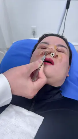 #nangmui #nangmuicautruc #nangmuiphongthuy #bacsilamdep #catmi #cangdamat #doncam #chuyensuamui #caymotrungbi #suamuihong #bacsinangmuidep #doncam #tiemfiler #cangdamini #hutmo #nangnguc #gotham