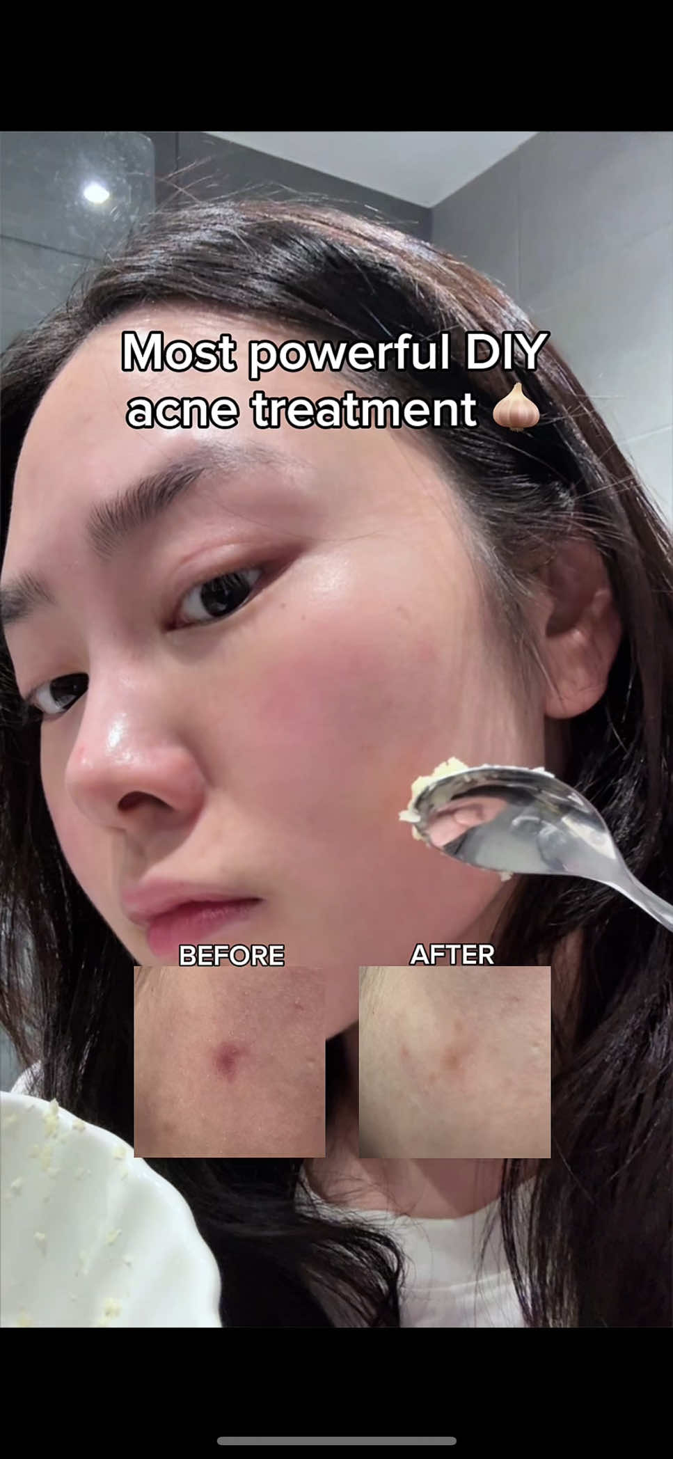 The most powerful DIY garlic acne treatment? 🧄 NOOO ❌ NEVER put raw garlic on your acne! In fact, it actually worsens acne. I’ll leave it to @VT Cosmetics US Garlic AC Reedle Shot Spot Cream 🧄💉 Available at: 🛍️ Yesstyle: GLOWITHJA5 🛍️ Olive Young Global: GLOWITHJA5 . . . #kbeauty #koreanskincare #vtcosmetics #garlic #garlicreedleshot #garlicforacne #acnetreatment #acne #acneskin #acneskincare #pimples #acneproneskin #acneproneskincare #creatorsearchinsights 