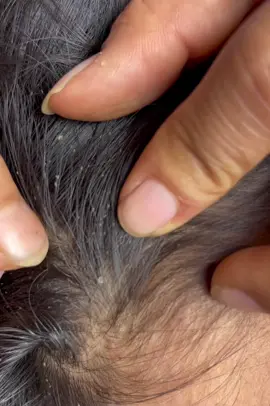 Too many lice #itchy #😳😲😳 #liceremoval #tripofobia 